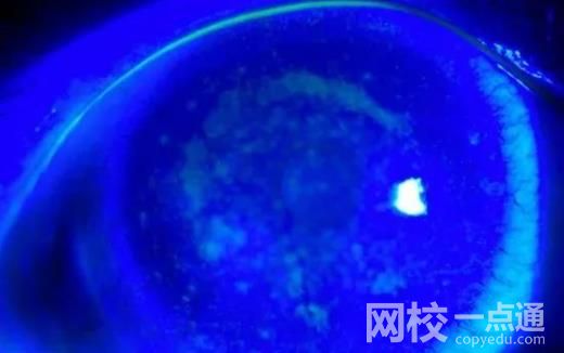 女子戴隱形10年角膜長(zhǎng)滿新生血管 隨后被確診雙眼瞼緣炎結(jié)膜炎干眼癥