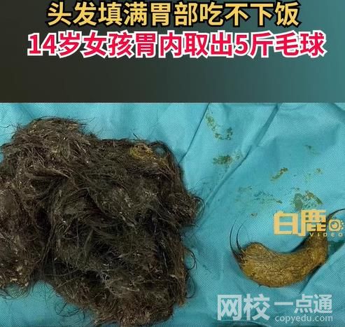 女孩吃頭發(fā)胃里取出5斤毛球 具體是什么情況?