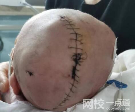 嬰兒出生后顱骨骨折 醫(yī)院回應(yīng) 始料未及真相簡直令人崩潰