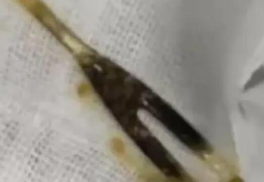 男子腹痛三月以為是腫瘤結果是叉子 到底是怎么進去的？
