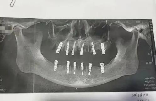 一次性拔牙23顆種12顆 13天后去世 實(shí)在太悲劇