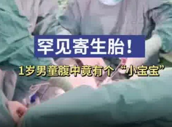 1歲男童腹中竟有個(gè)小寶寶 實(shí)在太罕見(jiàn)了