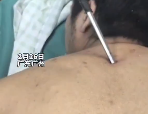 高空掉落30cm螺絲刀直插男子胸腔 簡(jiǎn)直太嚇人了