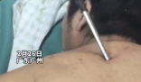 高空掉落30cm螺絲刀直插男子胸腔 簡(jiǎn)直太嚇人了