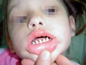長哪吒同款鯊魚牙可能患有罕見病 究竟是什么樣的？