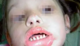 長(zhǎng)哪吒同款鯊魚牙可能患有罕見病 究竟是什么樣的？