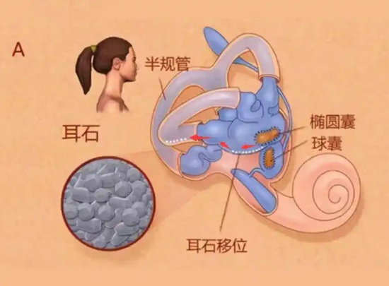25歲女子長期熬夜打麻將患耳石癥 究竟是怎么回事？