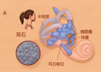 25歲女子長(zhǎng)期熬夜打麻將患耳石癥 究竟是怎么回事？