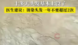 男子一月染頭4次致頭發(fā)大量脫落 實在太無奈了