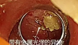 老人突發(fā)高燒拍胸片意外發(fā)現(xiàn)魚(yú)鉤 這也太恐怖了