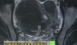 女子愛生悶氣子宮里長(zhǎng)了8個(gè)瘤 實(shí)在太恐怖了