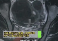 女子愛(ài)生悶氣子宮里長(zhǎng)了8個(gè)瘤 實(shí)在太恐怖了