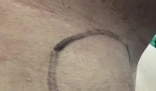 男子甲狀腺結(jié)節(jié)沒(méi)在意 2年后癌變 背后真相實(shí)在讓人驚愕