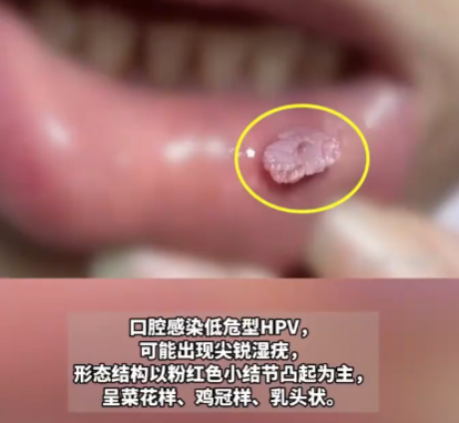 這種口腔潰瘍可能是HPV病毒感染 實(shí)在太可怕了