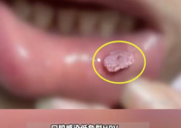 這種口腔潰瘍可能是HPV病毒感染 實(shí)在太可怕了