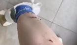 女子被寵物貓咬傷腿部潰爛 究竟是怎么回事？