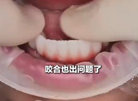 女子花6萬(wàn)植12顆牙2年調(diào)試20多次 究竟是怎么回事？