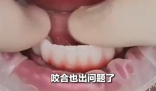 女子花6萬(wàn)植12顆牙2年調(diào)試20多次 究竟是怎么回事？