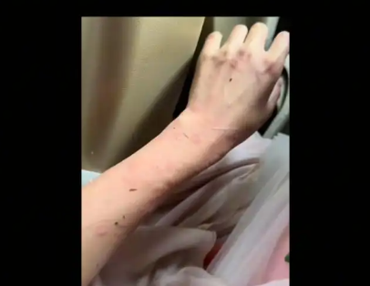 女演員貴州拍戲遇極端天氣 胳膊受傷 實(shí)在太嚇人了